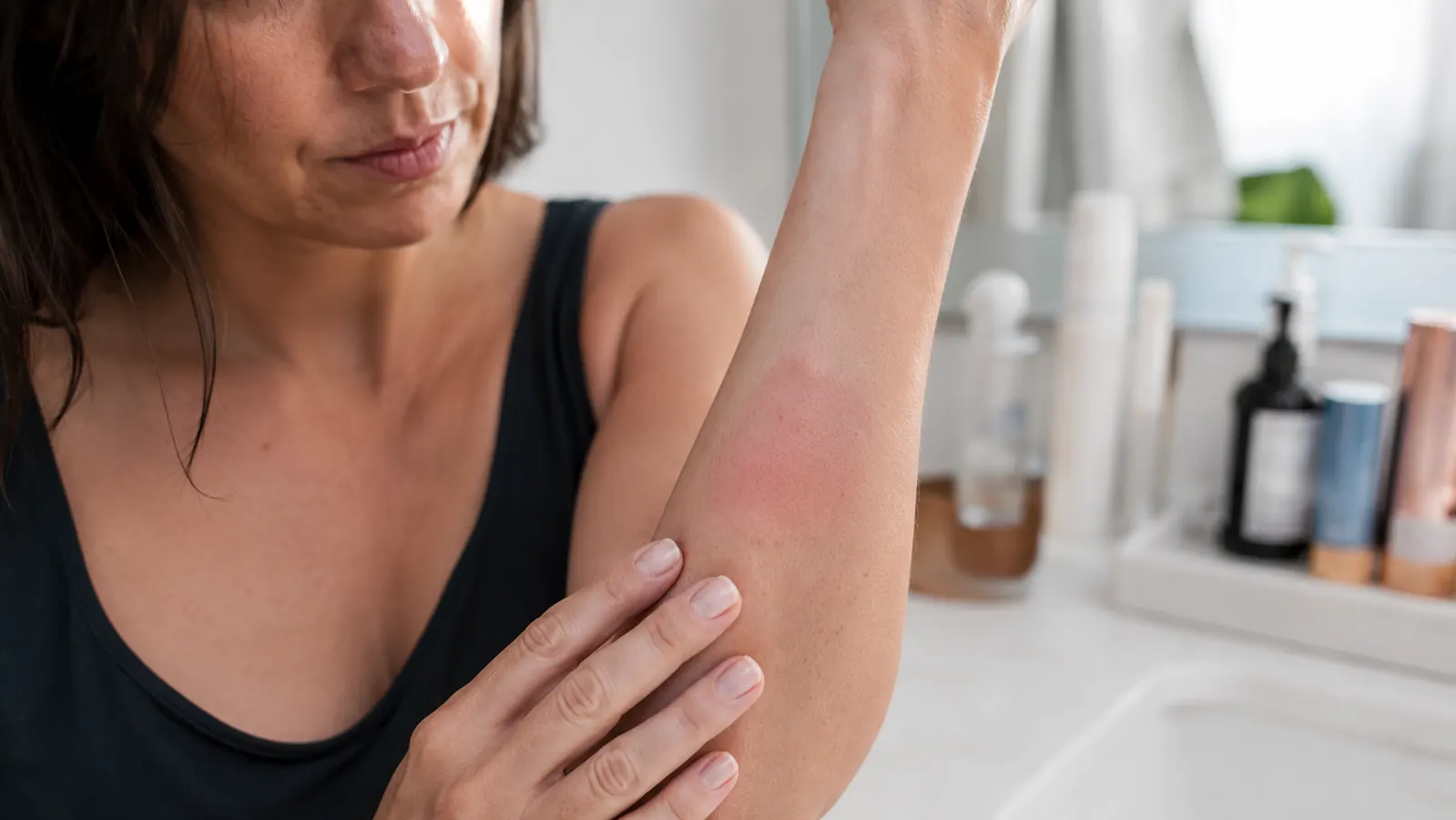 Woman's forearm showing a small red mark near the wrist from a straightener brush accidentally touching skin